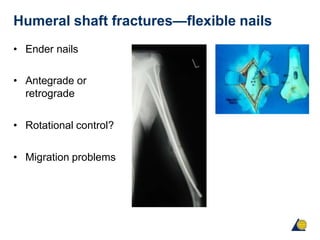 Humeral shaft fractures—flexible nails
• Ender nails
• Antegrade or
retrograde
• Rotational control?
• Migration problems
 