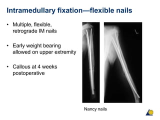 Intramedullary fixation—flexible nails
• Multiple, flexible,
retrograde IM nails
• Early weight bearing
allowed on upper extremity
• Callous at 4 weeks
postoperative
Nancy nails
 