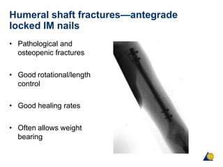 Humeral shaft fractures—antegrade
locked IM nails
• Pathological and
osteopenic fractures
• Good rotational/length
control
• Good healing rates
• Often allows weight
bearing
 