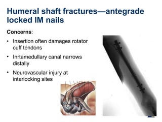 Humeral shaft fractures—antegrade
locked IM nails
Concerns:
•
•
• Insertion often damages rotator
cuff tendons
Inrtamedullary canal narrows
distally
Neurovascular injury at
interlocking sites
X
 