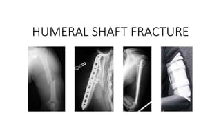HUMERAL SHAFT FRACTURE
 