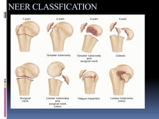 Nehr Classification humerus bone and complications of fracture | PPTX