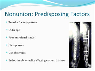 Nonunion: Predisposing Factors
 Transfer fracture pattern
 Older age
 Poor nutritional status
 Osteoporosis
 Use of steroids
 Endocrine abnormality affecting calcium balance
 