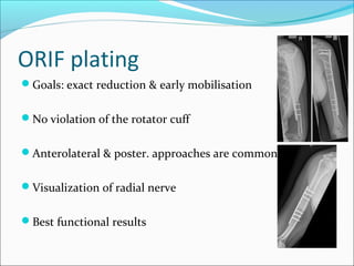 ORIF plating
Goals: exact reduction & early mobilisation
No violation of the rotator cuff
Anterolateral & poster. approaches are common
Visualization of radial nerve
Best functional results
 