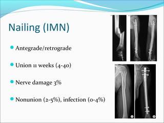 Nailing (IMN)
Antegrade/retrograde
Union 11 weeks (4-40)
Nerve damage 3%
Nonunion (2-5%), infection (0-4%)
 