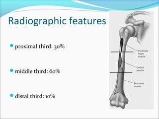 Radiographic features
proximal third: 30%
middle third: 60%
distal third: 10%
 