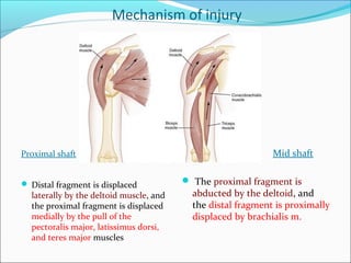 Mechanism of injury
Proximal shaft
 Distal fragment is displaced
laterally by the deltoid muscle, and
the proximal fragment is displaced
medially by the pull of the
pectoralis major, latissimus dorsi,
and teres major muscles
Mid shaft
 The proximal fragment is
abducted by the deltoid, and
the distal fragment is proximally
displaced by brachialis m.
 