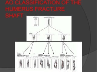 AO CLASSIFICATION OF THE
HUMERUS FRACTURE
SHAFT
 