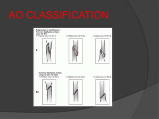AO CLASSIFICATION
 