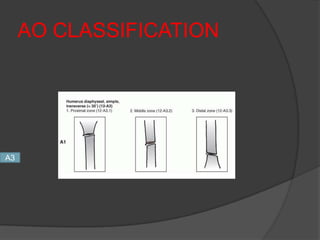 AO CLASSIFICATION




A3
 