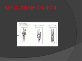 AO CLASSIFICATION
 