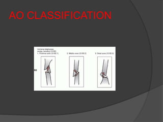 AO CLASSIFICATION
 