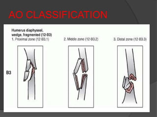 AO CLASSIFICATION
 