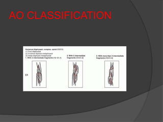 AO CLASSIFICATION
 