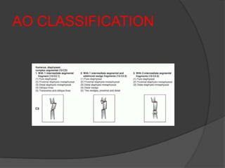 AO CLASSIFICATION
 