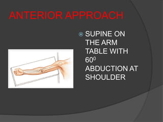 ANTERIOR APPROACH
           SUPINEON
           THE ARM
           TABLE WITH
           600
           ABDUCTION AT
           SHOULDER
 
