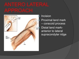 ANTERO LATERAL
APPROACH
             Incision
             Proximal land mark
              – coracoid process
             Distal land mark-
              anterior to lateral
              supracondylar ridge
 