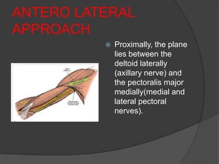 ANTERO LATERAL
APPROACH
             Proximally, the plane
              lies between the
              deltoid laterally
              (axillary nerve) and
              the pectoralis major
              medially(medial and
              lateral pectoral
              nerves).
 