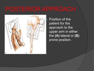 POSTERIOR APPROACH
             Position of the
              patient for the
              approach to the
              upper arm in either
              the (A) lateral or (B)
              prone position.
 