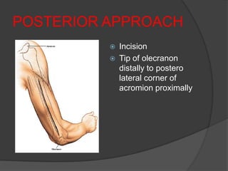POSTERIOR APPROACH
             Incision
             Tip of olecranon
              distally to postero
              lateral corner of
              acromion proximally
 
