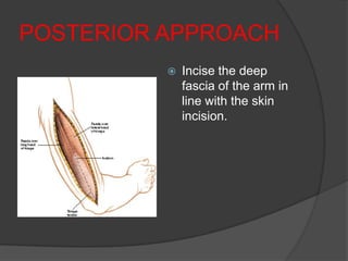 POSTERIOR APPROACH
             Incise the deep
              fascia of the arm in
              line with the skin
              incision.
 