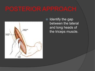 POSTERIOR APPROACH
             Identify the gap
              between the lateral
              and long heads of
              the triceps muscle.
 