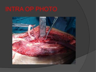INTRA OP PHOTO
 