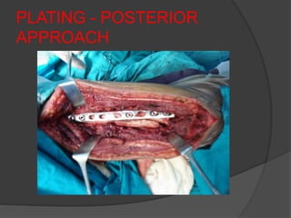 PLATING - POSTERIOR
APPROACH
 