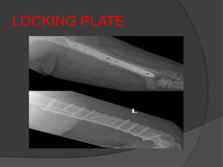 LOCKING PLATE
 