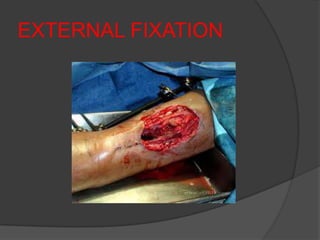 EXTERNAL FIXATION
 