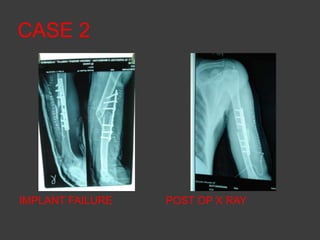 CASE 2




IMPLANT FAILURE   POST OP X RAY
 