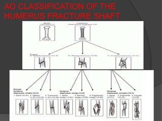 AO CLASSIFICATION OF THE
HUMERUS FRACTURE SHAFT
 