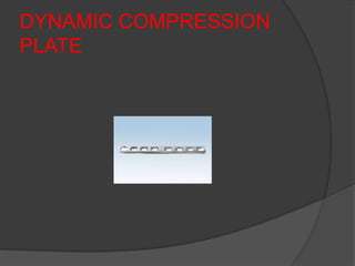 DYNAMIC COMPRESSION
PLATE
 