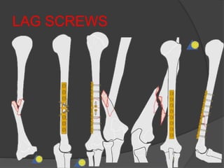 LAG SCREWS
 
