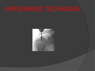 ANTEGRADE TECHNIQUE
 