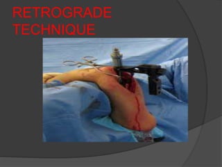 RETROGRADE
TECHNIQUE
 