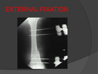 EXTERNAL FIXATION
 