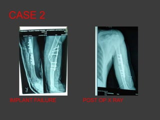 CASE 2
IMPLANT FAILURE POST OP X RAY
 