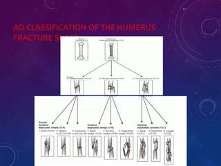 AO CLASSIFICATION OF THE HUMERUS
FRACTURE SHAFT
 