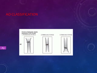 AO CLASSIFICATION
A3
 