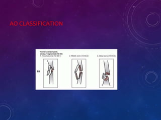 AO CLASSIFICATION
 