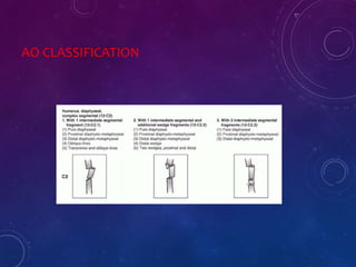 AO CLASSIFICATION
 