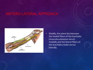 ANTERO LATERAL APPROACH
• Distally, the plane lies between
the medial fibers of the brachialis
(musculocutaneous nerve)
medially and the lateral fibers of
the brachialis (radial nerve)
laterally.
 