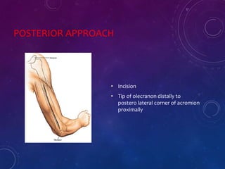 POSTERIOR APPROACH
• Incision
• Tip of olecranon distally to
postero lateral corner of acromion
proximally
 