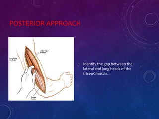 POSTERIOR APPROACH
• Identify the gap between the
lateral and long heads of the
triceps muscle.
 