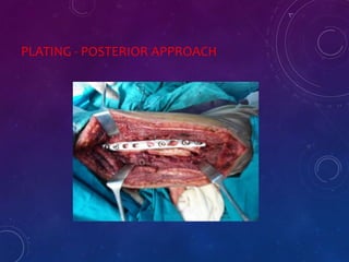 PLATING - POSTERIOR APPROACH
 