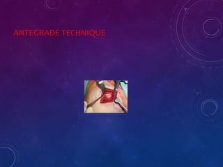 ANTEGRADE TECHNIQUE
 