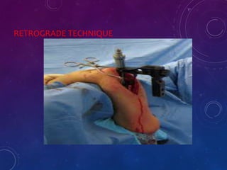 RETROGRADE TECHNIQUE
 