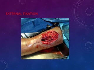 EXTERNAL FIXATION
 