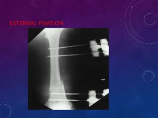 EXTERNAL FIXATION
 